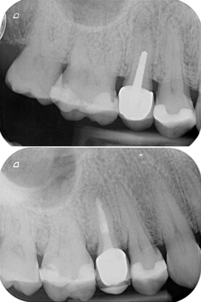 Zahn-Care Reutlingen-Endo Behandlung