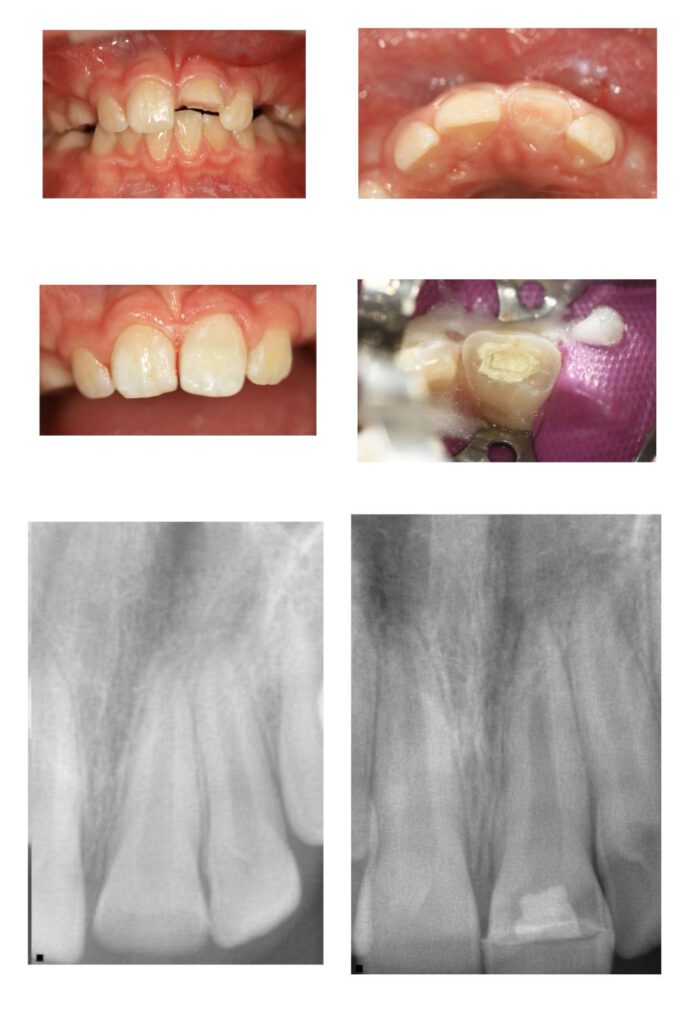 Zahn-Care Reutlingen-Endo Behandlung