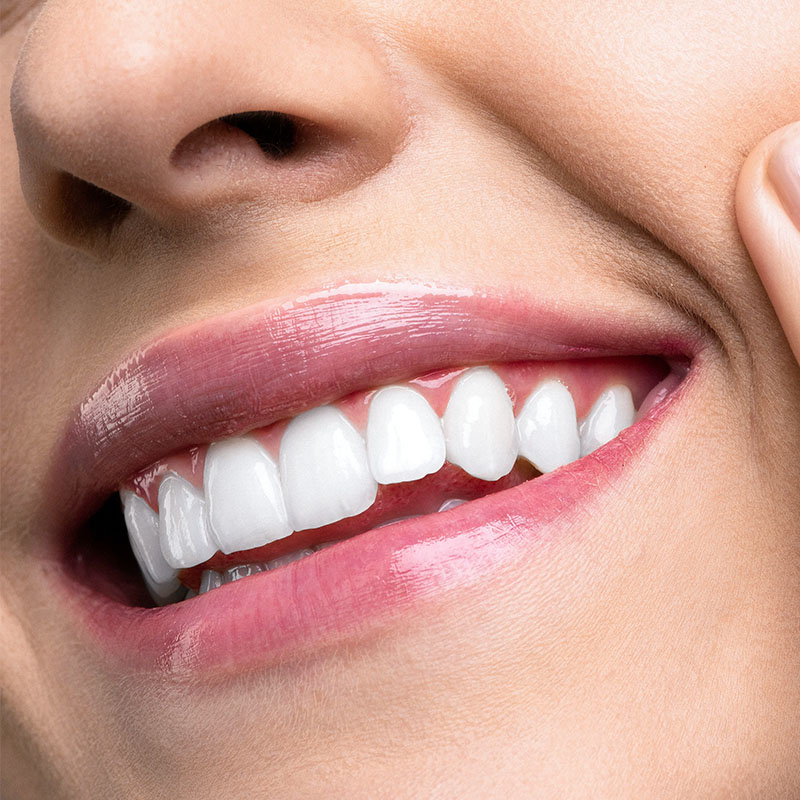 Zahn-Care-Praxis-Zahnaufhellung