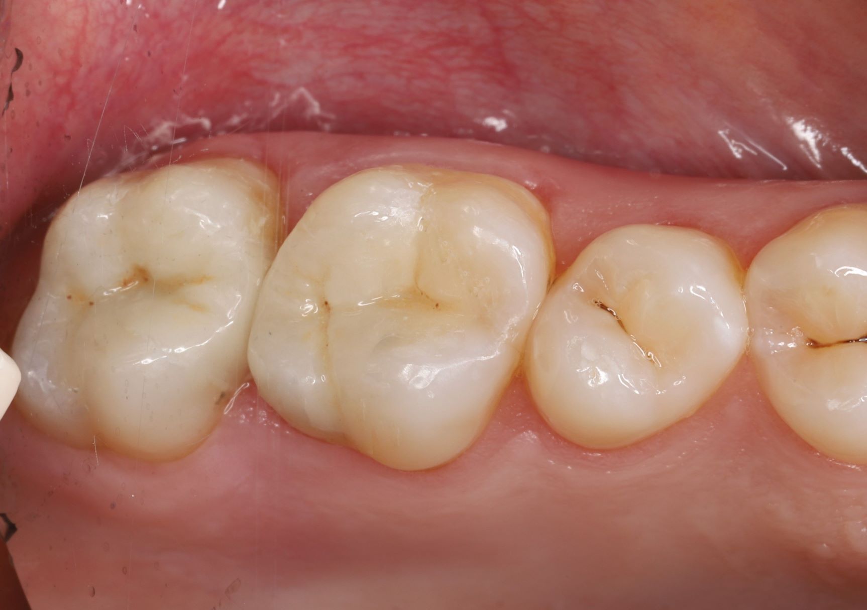 Zahnarzt Reutlingen - Füllungen nach der Behandlung