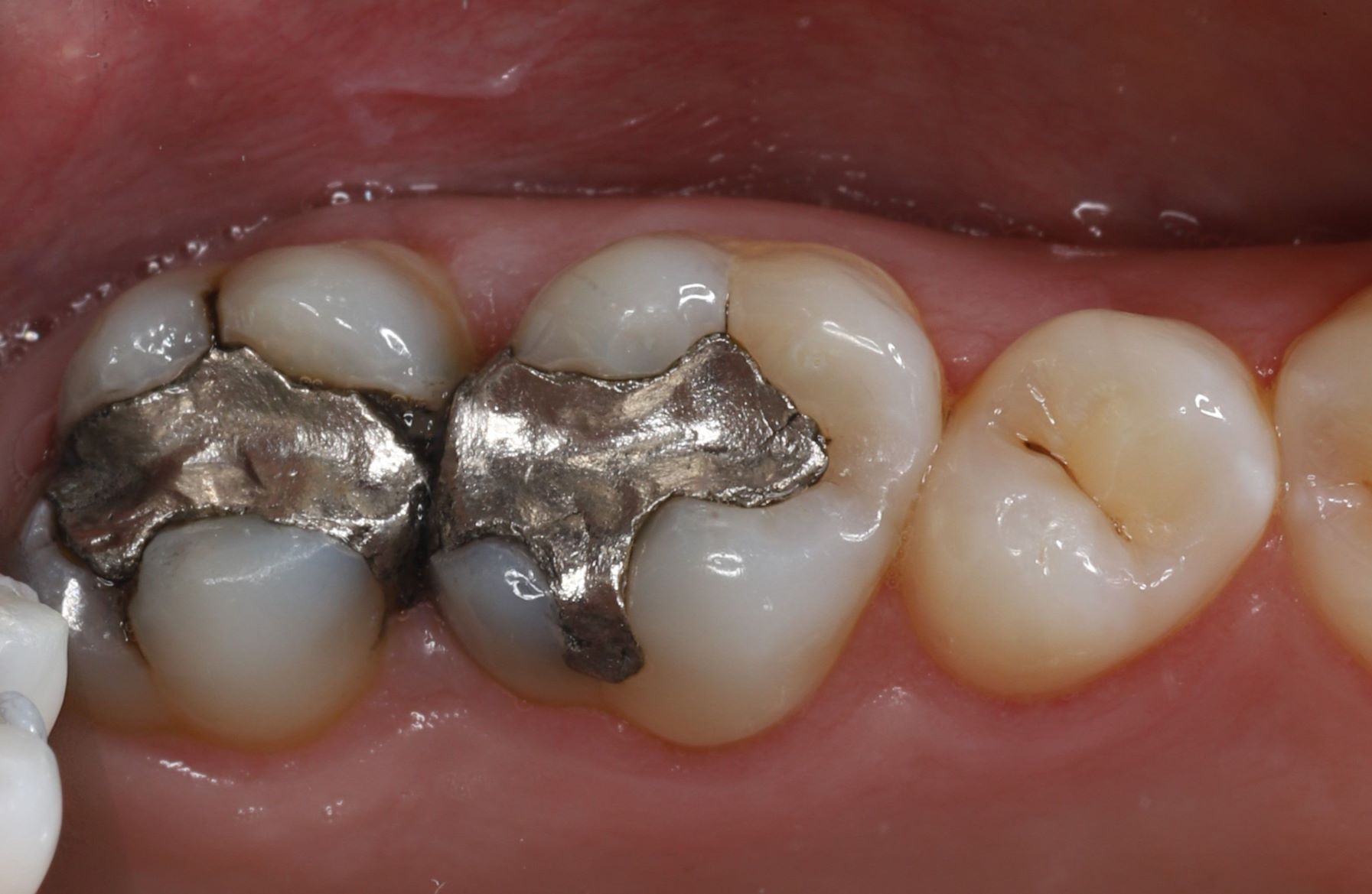 Zahnarzt Reutlingen - Füllungen vor der Behandlung