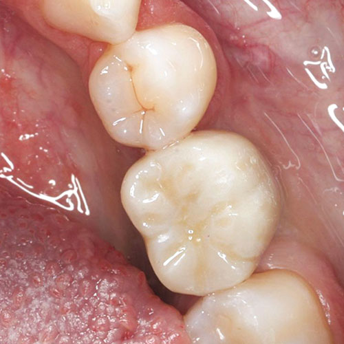 Zahnarzt Reutlingen Implantat -- nachher