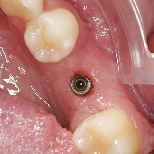 Zahnarzt Reutlingen Implantat - vorher