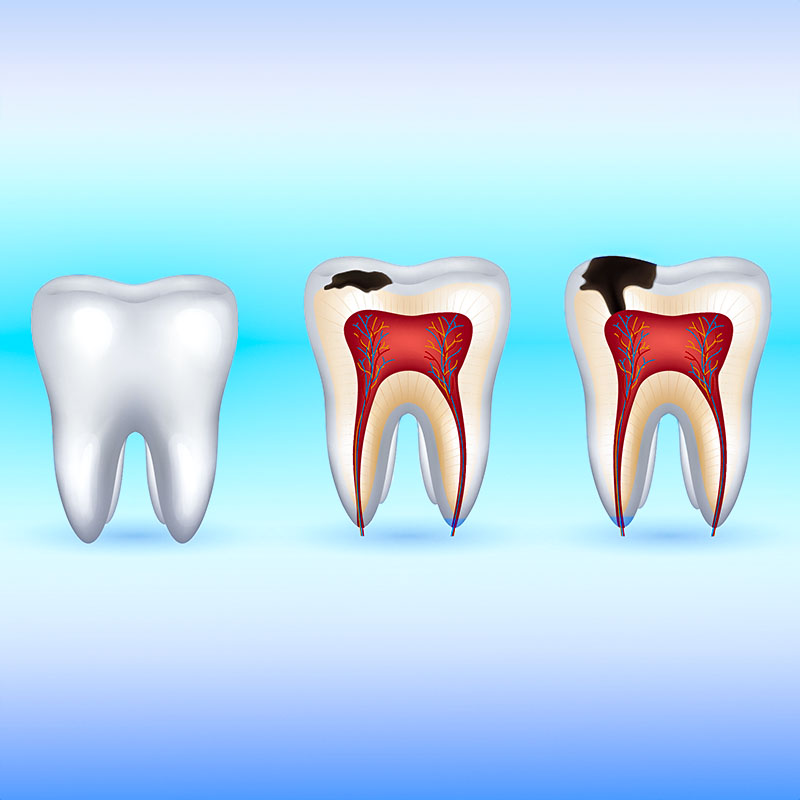 Zahnarzt Zahn-Care Reutlingen - Füllungstherapie mit Portlandzement
