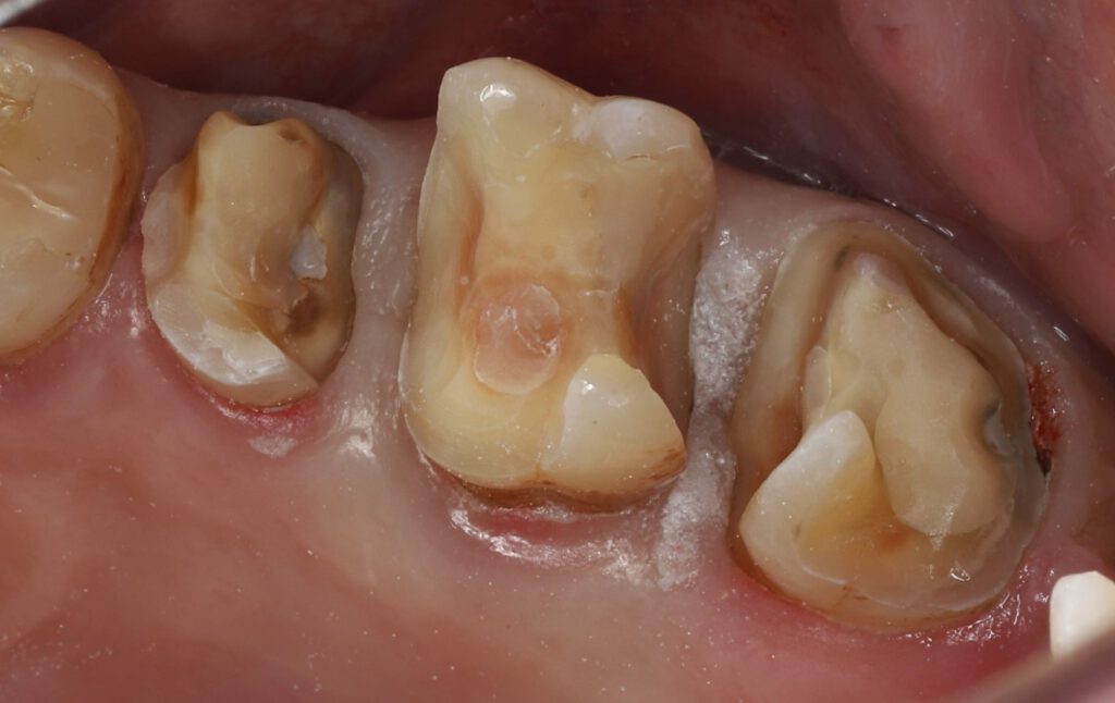 Zahnarzt Zahn-Care Reutlingen - während der Behandlung